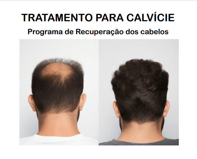 TRATAMENTO PARA CALVÍCIE